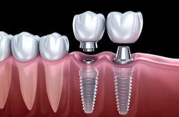 Unveiling the Role of Microbiomes in Dental Implant Success
