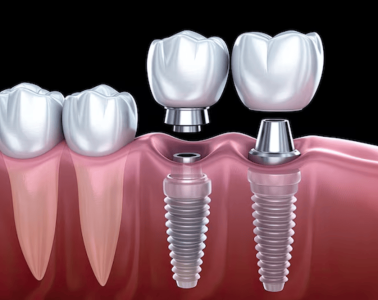 Unveiling the Role of Microbiomes in Dental Implant Success