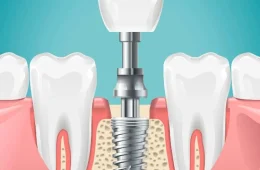 The Evolutionary Impact of Dental Implants on Oral Microbiome