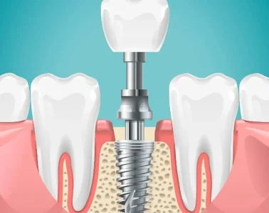 The Evolutionary Impact of Dental Implants on Oral Microbiome