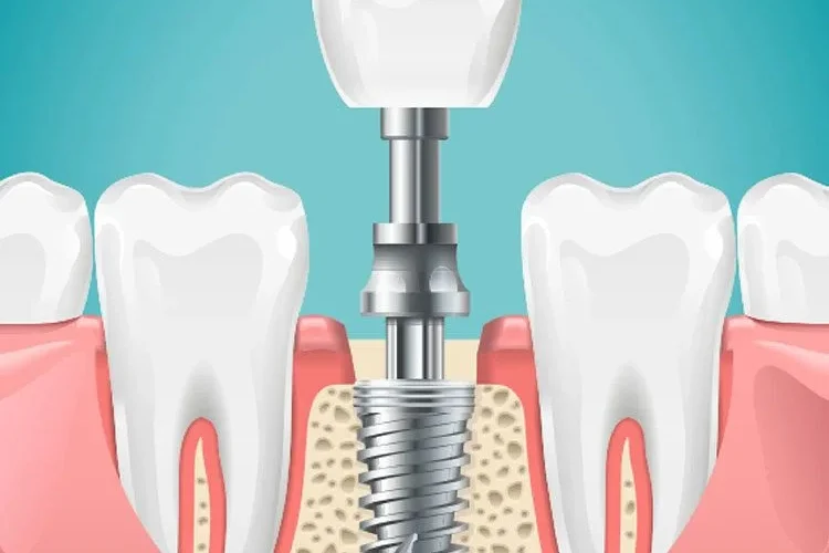 The Evolutionary Impact of Dental Implants on Oral Microbiome