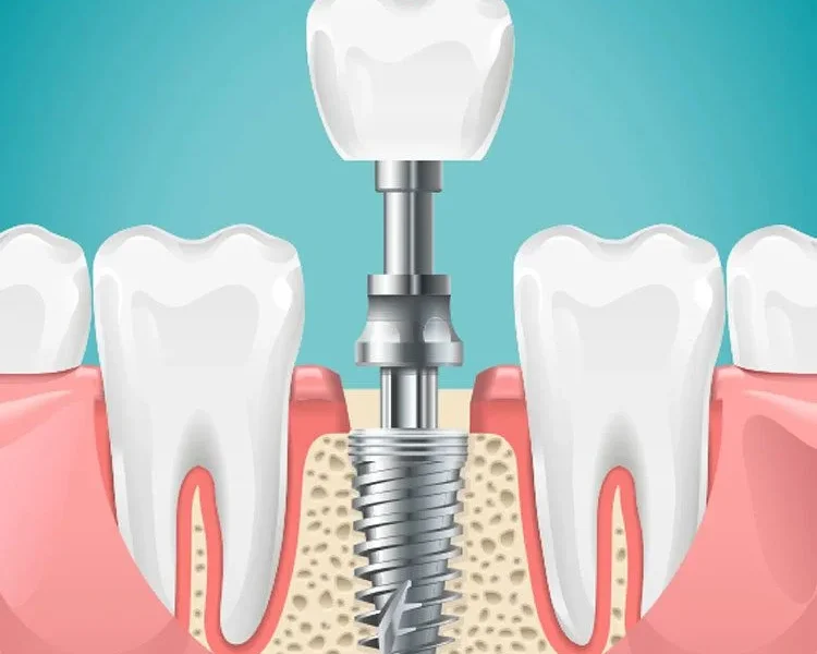 The Evolutionary Impact of Dental Implants on Oral Microbiome